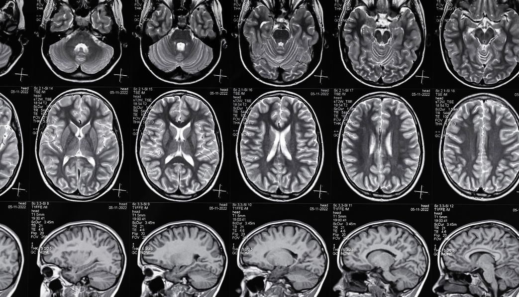 You are currently viewing Anoxic Brain Injury Prognosis and Survival Rates: Key Factors that Shape Recovery